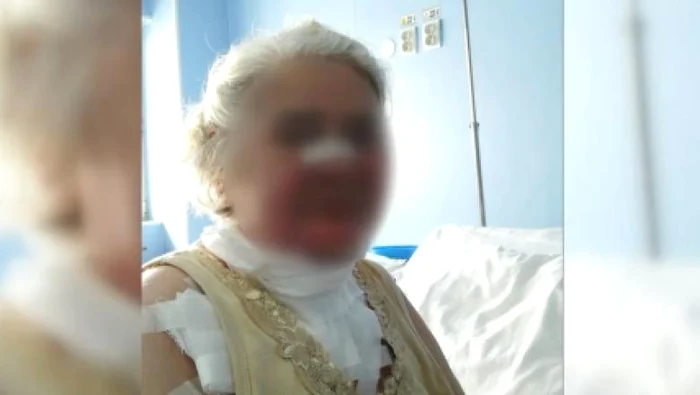 
    Femeia a suferit arsuri pe faţă după ce un aparat a luat foc în sala de operaţiefoto: captură video Digi 24  