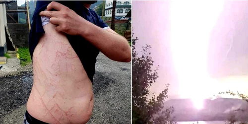 Urme lăsate de fulger pe corpul unui om  Foto Salvamont Argeș Facebook jpg