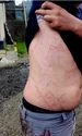 Urme lăsate de fulger pe corpul unui om  Foto Salvamont Argeș Facebook jpg