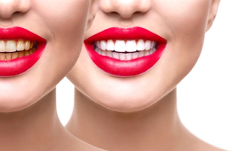 dinti albi shutterstock 673659349 jpg