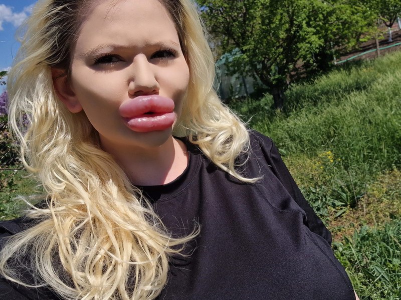 Femeia cu cele mai mari buze din lume și-a mărit și nasul. Pentru ce a făcut „experimentul” care i-a pus viaţa în pericol