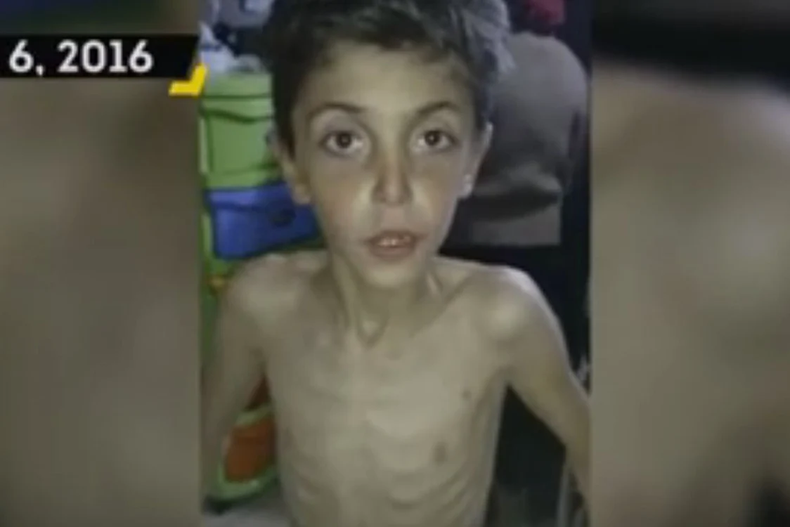 
    Aşa arată unul dintre copiii subnutriţi din Madayacaptură video  
