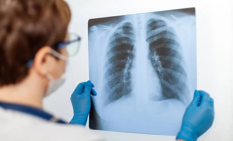 Poluarea aerului, un factor major de risc pentru una dintre cele mai frecvente forme de cancer