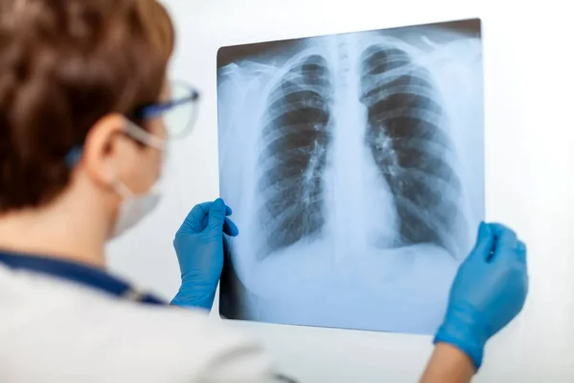  Cancerul pulmonar este tipul de cancer cu mortalitatea cea mai mare în România FOTO: Arhivă