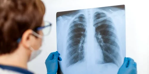 cancer pulmonar 2 jpg