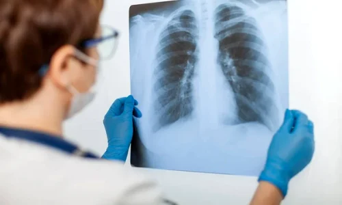 cancer pulmonar 2 jpg