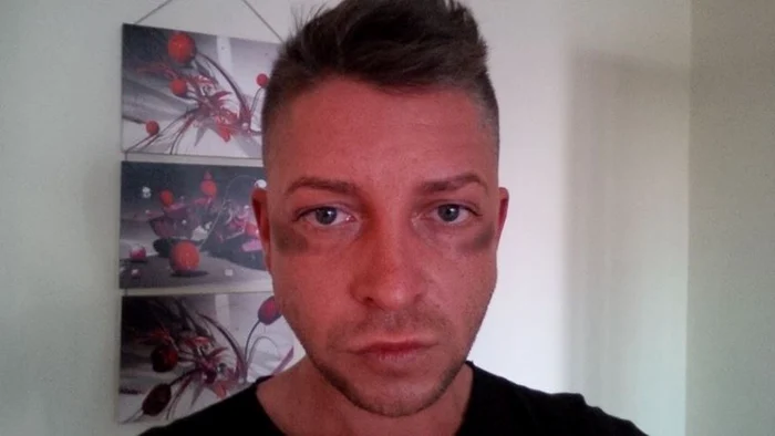 
    Aşa arată Ovidiu după "întâlnirea" cu poliţiştii  