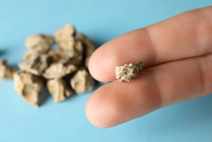 Pietrele la rinichi pot varia în dimensiuni / foto: Shutterstock