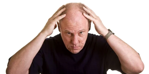 Alopecia androgenetică duce la pierderea părului începând cu zone frunţii şi continuând cu creştetul capului