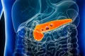 pancreatic cancer shutterstock 2264439379 (1) jpg