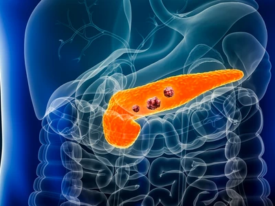 pancreatic cancer shutterstock 2264439379 (1) jpg