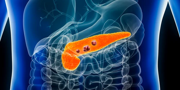 pancreatic cancer shutterstock 2264439379 (1) jpg