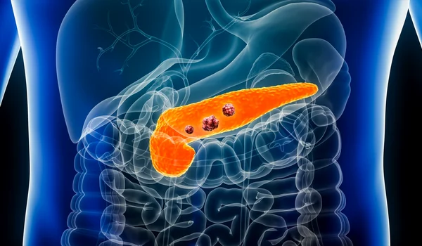 pancreatic cancer shutterstock 2264439379 (1) jpg