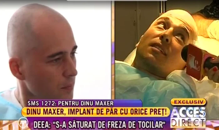 Dinu Maxer şi-a făcut implant de păr