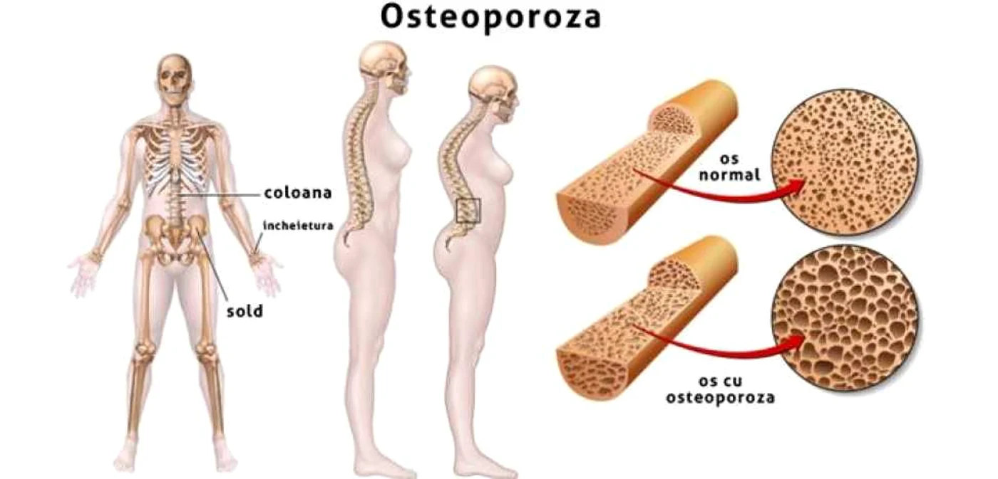osteoporoza