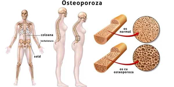 osteoporoza