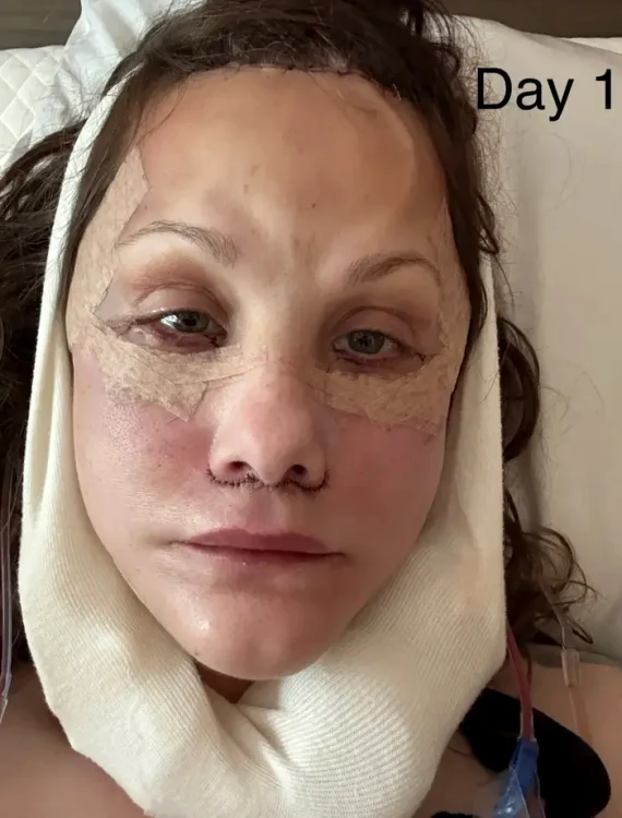 Transformarea unei femei i-a lăsat pe internauți cu gura căscată: „I-a șters 20 de ani!” Ea a apelat la lifting facial în Mexic 1 FOTO Michelle Wood