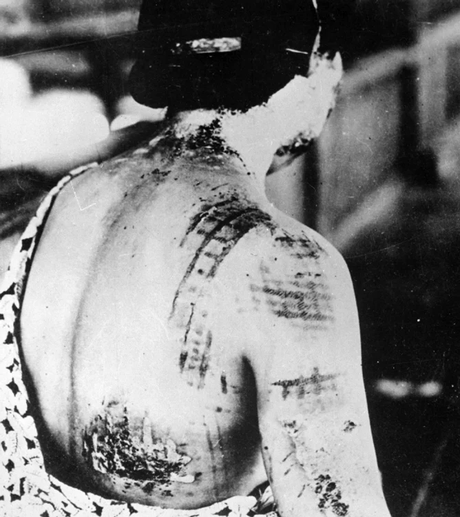 The patient's skin is burned in a pattern corresponding to the dark portions of a kimono   NARA   519686 jpg jpeg