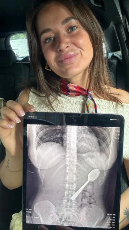 Medicii au decis să îi îndepărteze lingura sub anestezie locală FOTO: Jam Press