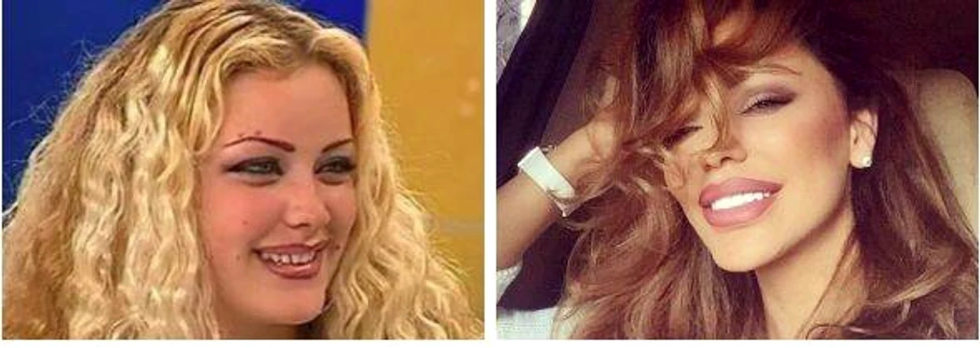 Bianca Drăgușanu a plătit 7.000 de euro pentru dantura perfectă de acum