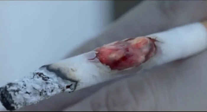 Fumatul cauzează cancer