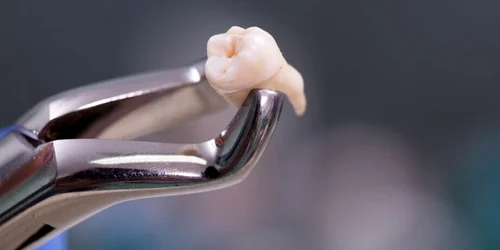 Extracția și tratamentul molarului de minte. FOTO: Arrowhead Dental 