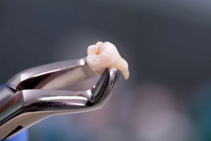 Extracția și tratamentul molarului de minte. FOTO: Arrowhead Dental 