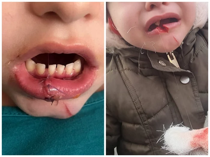 Fetița va avea nevoie de 11-12 zile de îngrijiri medicale FOTO: arhiva tata victima