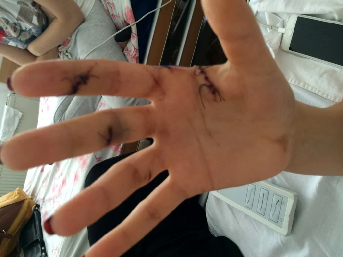 Aşa arată rănile adânci cu care fata s-a ales pe mâini şi torace după lupta cu portarul