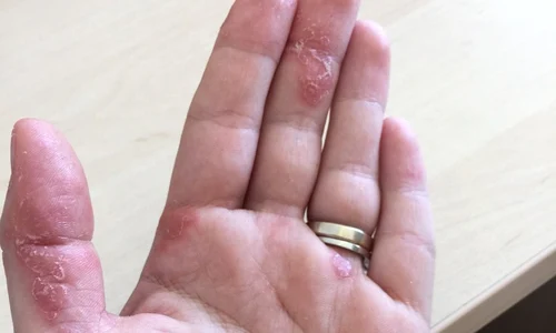 tili niculae psoriazis jpeg