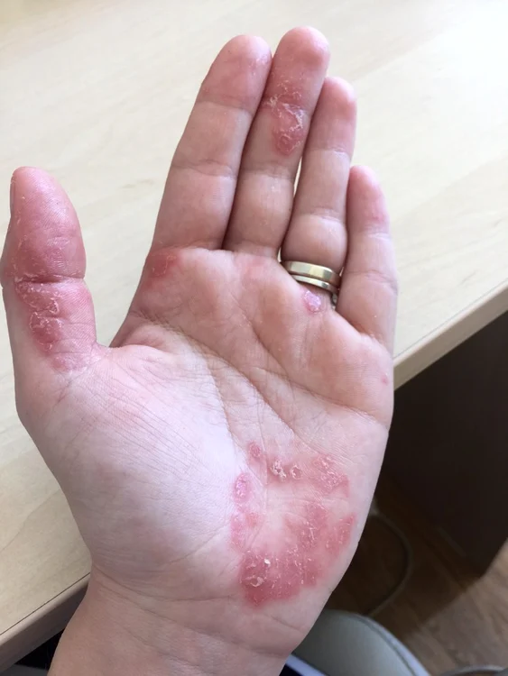 tili niculae psoriazis jpeg