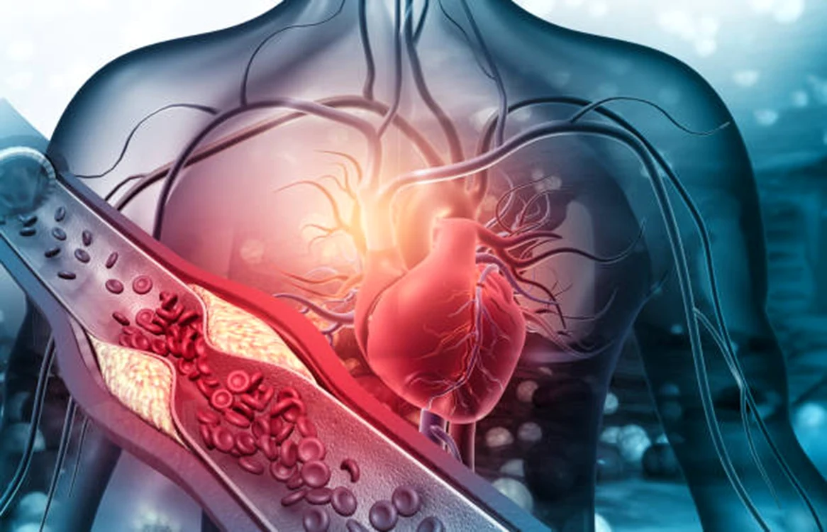 Ilustrație care arată modul în care colesterolul poate afecta inima Sursă iStock