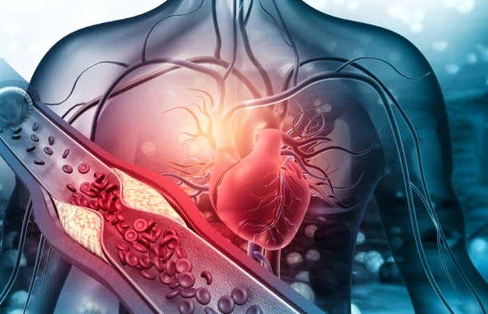 Ilustrație care arată modul în care colesterolul poate afecta inima Sursă iStock