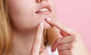 plasturi pentru cosuri cum previi tratezi acneea bland (1) jpg