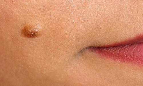 1 cum recunoastem alunitele periculoase jpg jpeg