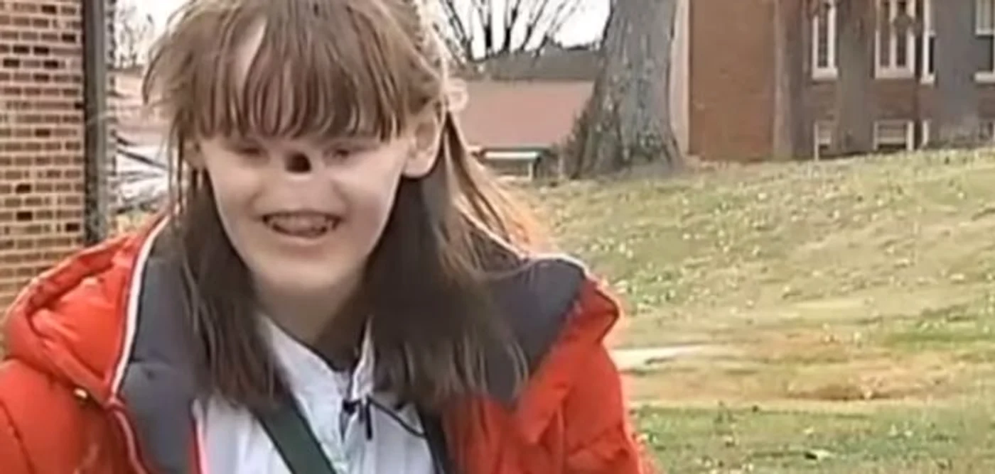 
    Cassidy s-a născut fără nas și fără ochiFoto: captură video  