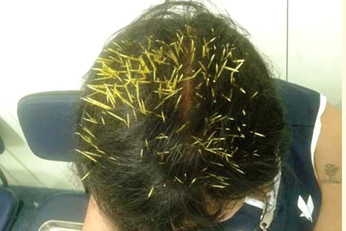 
    Sandra Nabucco a  primit antibiotice,  pentru a evita infecţiile (Foto: reuters)  