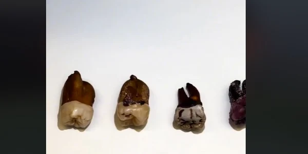 Experimentul unui dentist Foto Captură video TikTok jpg