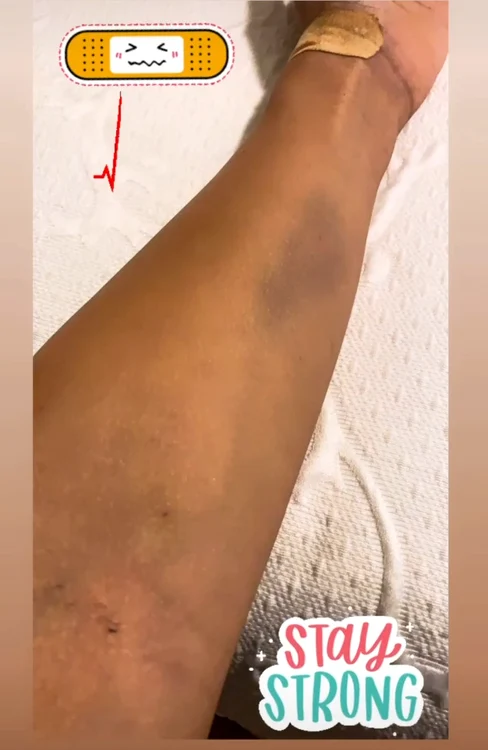 Amna, plină de vânătăi după Survivor România
