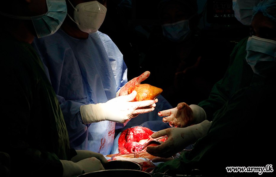 Cea mai mare piatră la rinichi din lume, îndepărtată chirurgical de medici din Sri Lanka FOTO