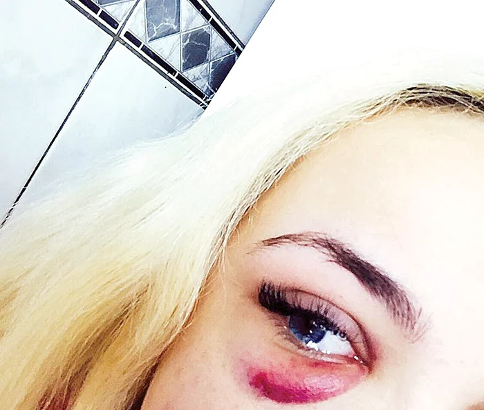 Barbie de România s-a învinețit, după ce a trecut pe la dentist