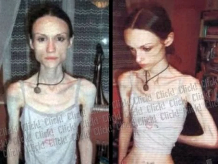Anorexia este o deviaţie comportamentală întâlnită mai frecvent în rândul adolescentelor Foto: Arhivă