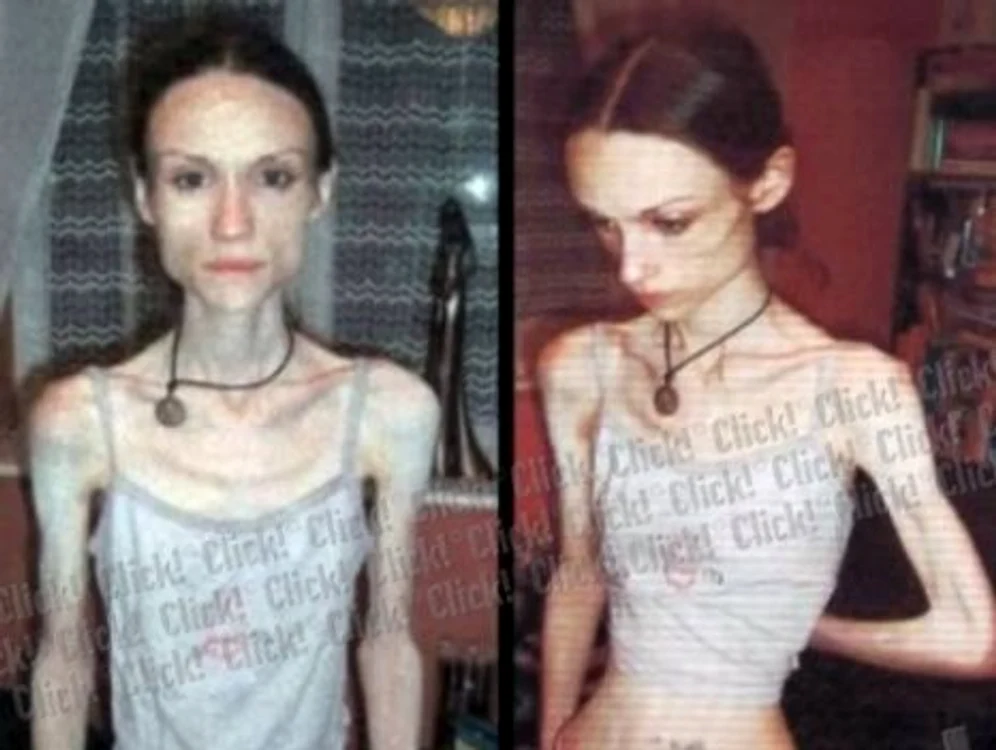Anorexia este o deviaţie comportamentală întâlnită mai frecvent în rândul adolescentelor Foto: Arhivă
