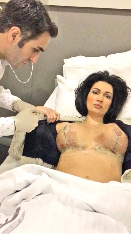 La finalul anului trecut, Nicoleta  Luciu şi-a scos  implanturile de  600 ml. Acum  are unele de 370  ml la fiecare sân