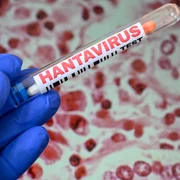 hantavirus getty jpeg