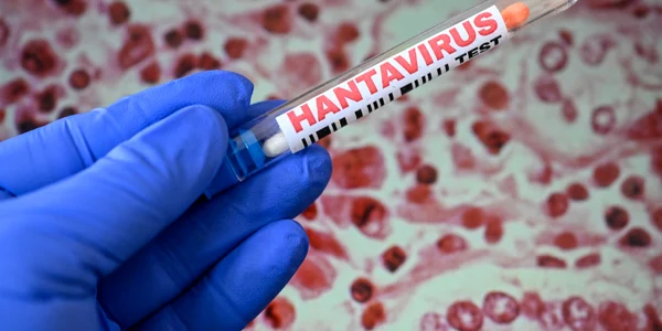 hantavirus getty jpeg