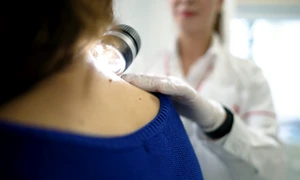 Centru multidisciplinar integrat pentru tratarea melanomului png