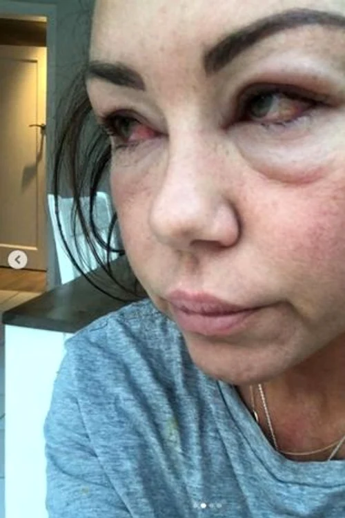 
    Michelle Heaton a postat imaginile pe Instagram pentru a arăta lumii întregi ce înseamnă dependența de alcool și droguriSursa foto: Instagram  