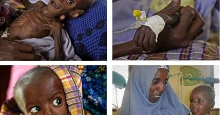 Un băiețel din Somalia a reuşit să supravieţuiască foametei 