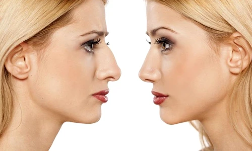 1 rinoplatie jpg jpeg